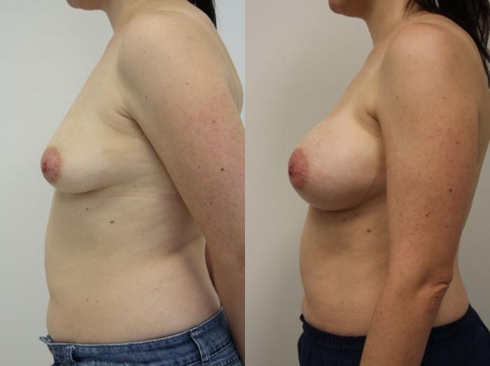 Before & After Breast Augmentation Case 19 View #3 View in Gilbert, AZ
