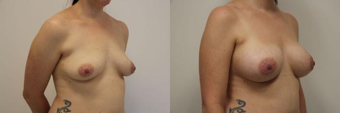 Before & After Breast Augmentation Case 19 View #4 View in Gilbert, AZ