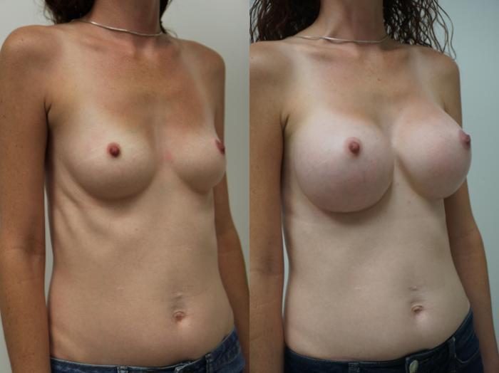 Before & After Breast Augmentation Case 193 View #1 View in Gilbert, AZ
