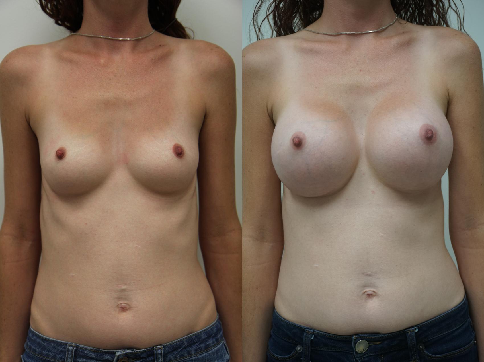 Before & After Breast Augmentation Case 193 View #2 View in Gilbert, AZ