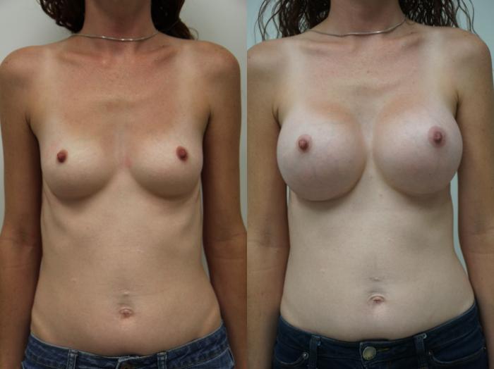 Before & After Breast Augmentation Case 193 View #2 View in Gilbert, AZ