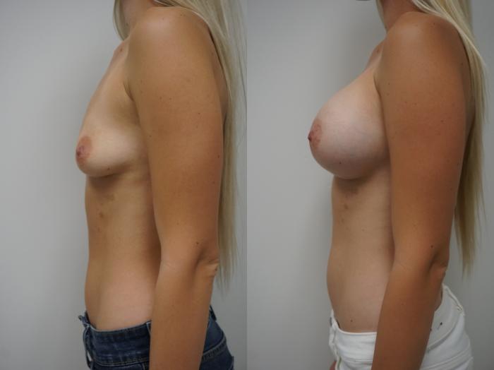 Before & After Breast Augmentation Case 195 View #1 View in Gilbert, AZ