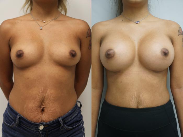 Before & After Breast Augmentation Case 203 View #1 View in Gilbert, AZ