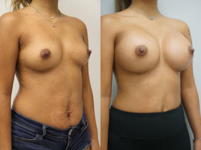 Before & After Breast Augmentation Case 203 View #2 View in Gilbert, AZ