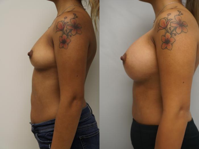 Before & After Breast Augmentation Case 203 View #3 View in Gilbert, AZ