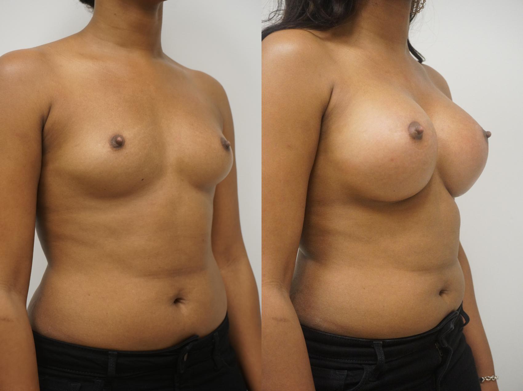 Before & After Breast Augmentation Case 206 View #1 View in Gilbert, AZ