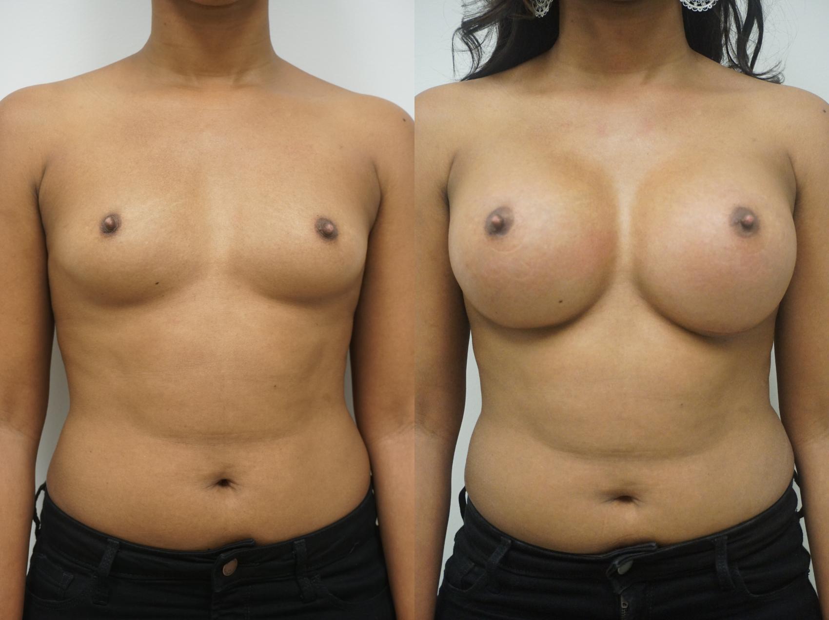 Before & After Breast Augmentation Case 206 View #2 View in Gilbert, AZ