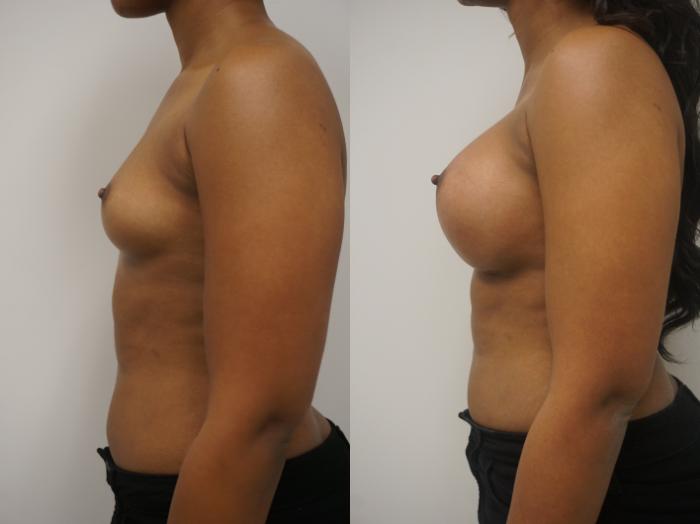 Before & After Breast Augmentation Case 206 View #3 View in Gilbert, AZ