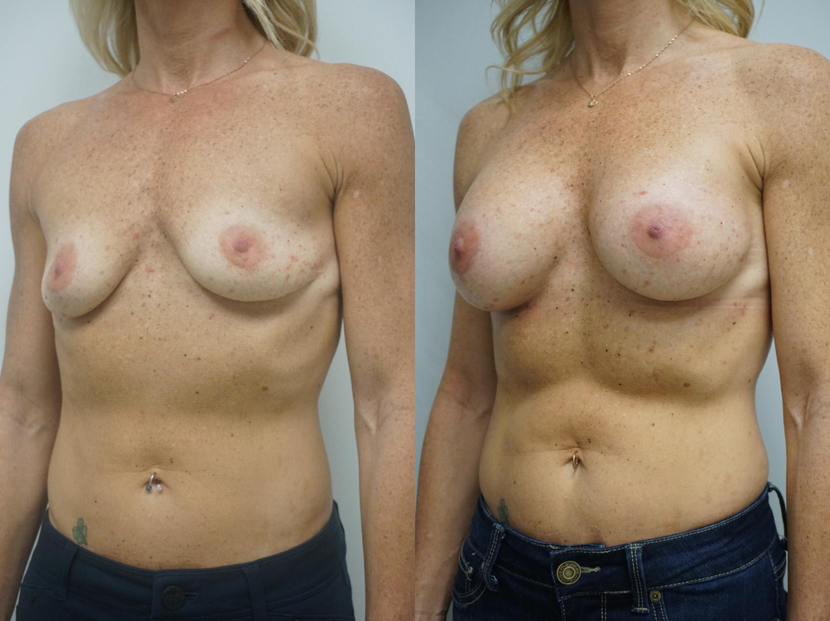 Before & After Breast Augmentation Case 207 View #1 View in Gilbert, AZ