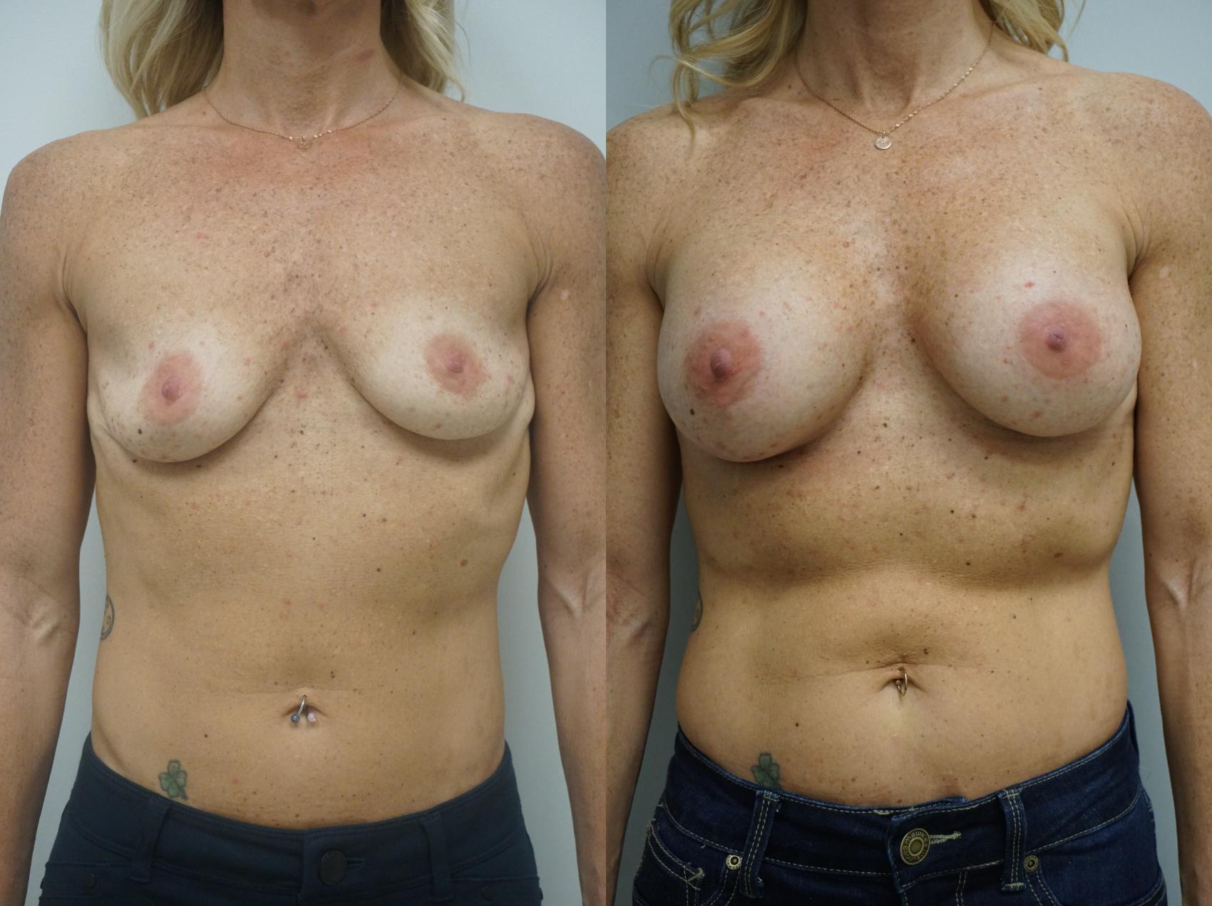 Before & After Breast Augmentation Case 207 View #2 View in Gilbert, AZ