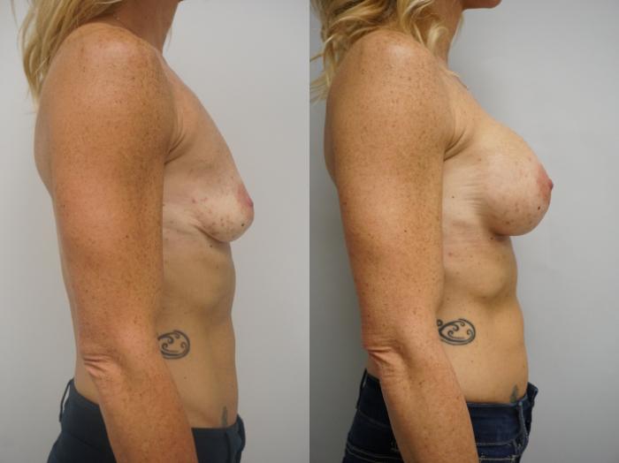 Before & After Breast Augmentation Case 207 View #3 View in Gilbert, AZ