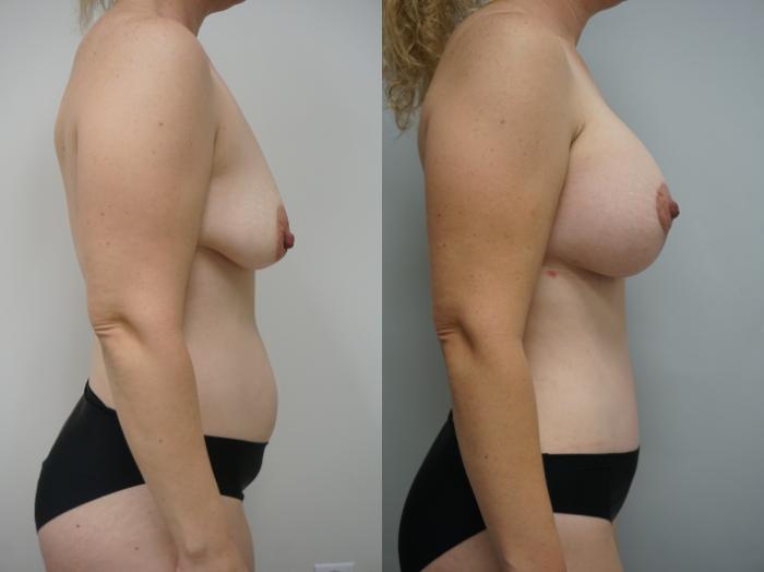 Before & After Breast Augmentation Case 210 View #1 View in Gilbert, AZ