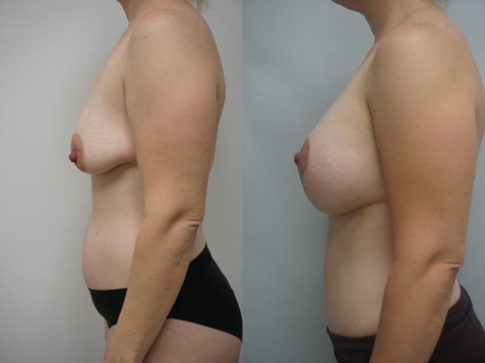 Before & After Breast Augmentation Case 210 View #2 View in Gilbert, AZ