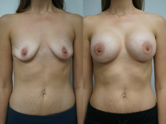 Before & After Breast Augmentation Case 211 View #1 View in Gilbert, AZ