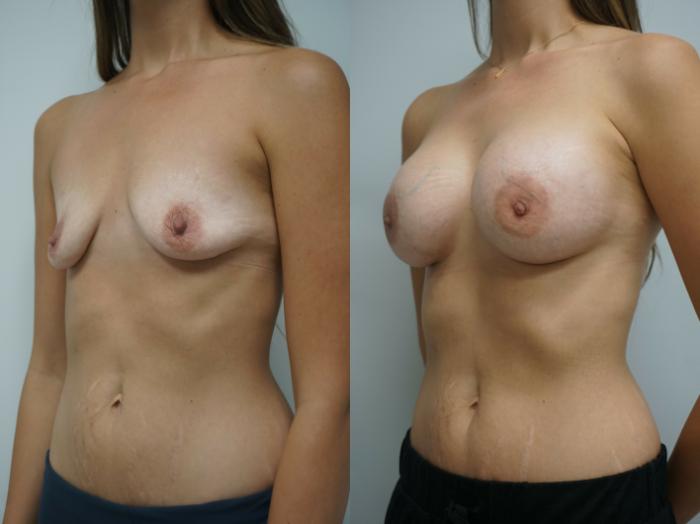 Before & After Breast Augmentation Case 211 View #2 View in Gilbert, AZ