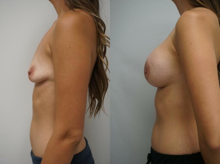 Before & After Breast Augmentation Case 211 View #3 View in Gilbert, AZ