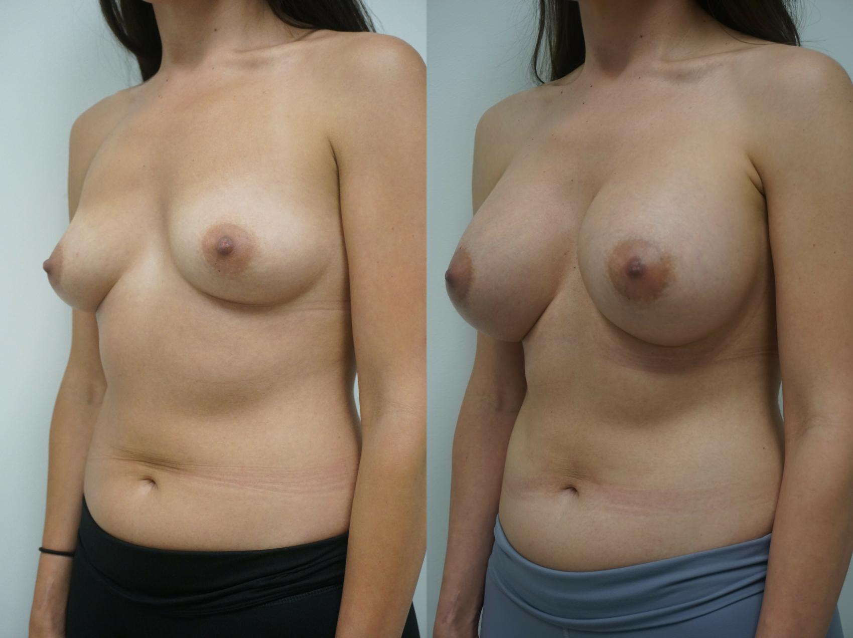 Before & After Breast Augmentation Case 212 View #1 View in Gilbert, AZ
