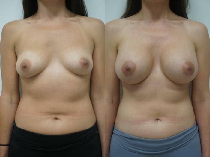 Before & After Breast Augmentation Case 212 View #2 View in Gilbert, AZ