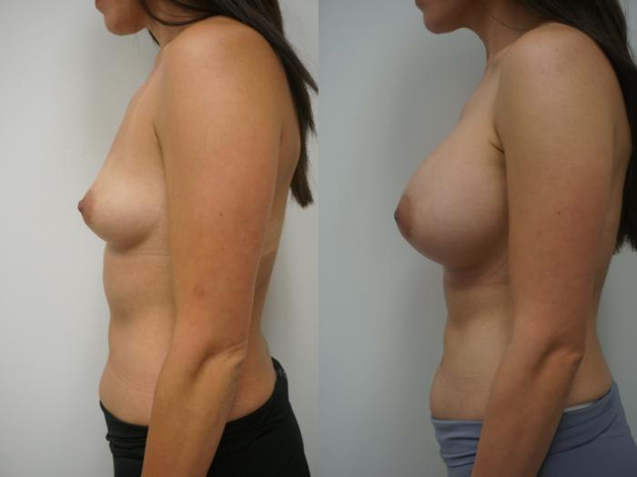 Before & After Breast Augmentation Case 212 View #3 View in Gilbert, AZ