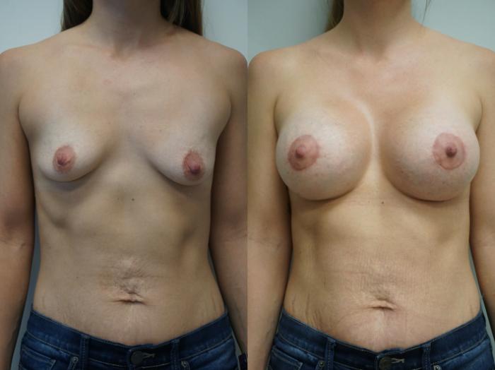 Before & After Breast Augmentation Case 215 View #2 View in Gilbert, AZ