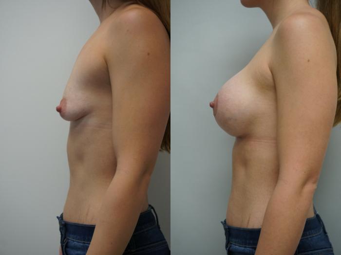 Before & After Breast Augmentation Case 215 View #3 View in Gilbert, AZ