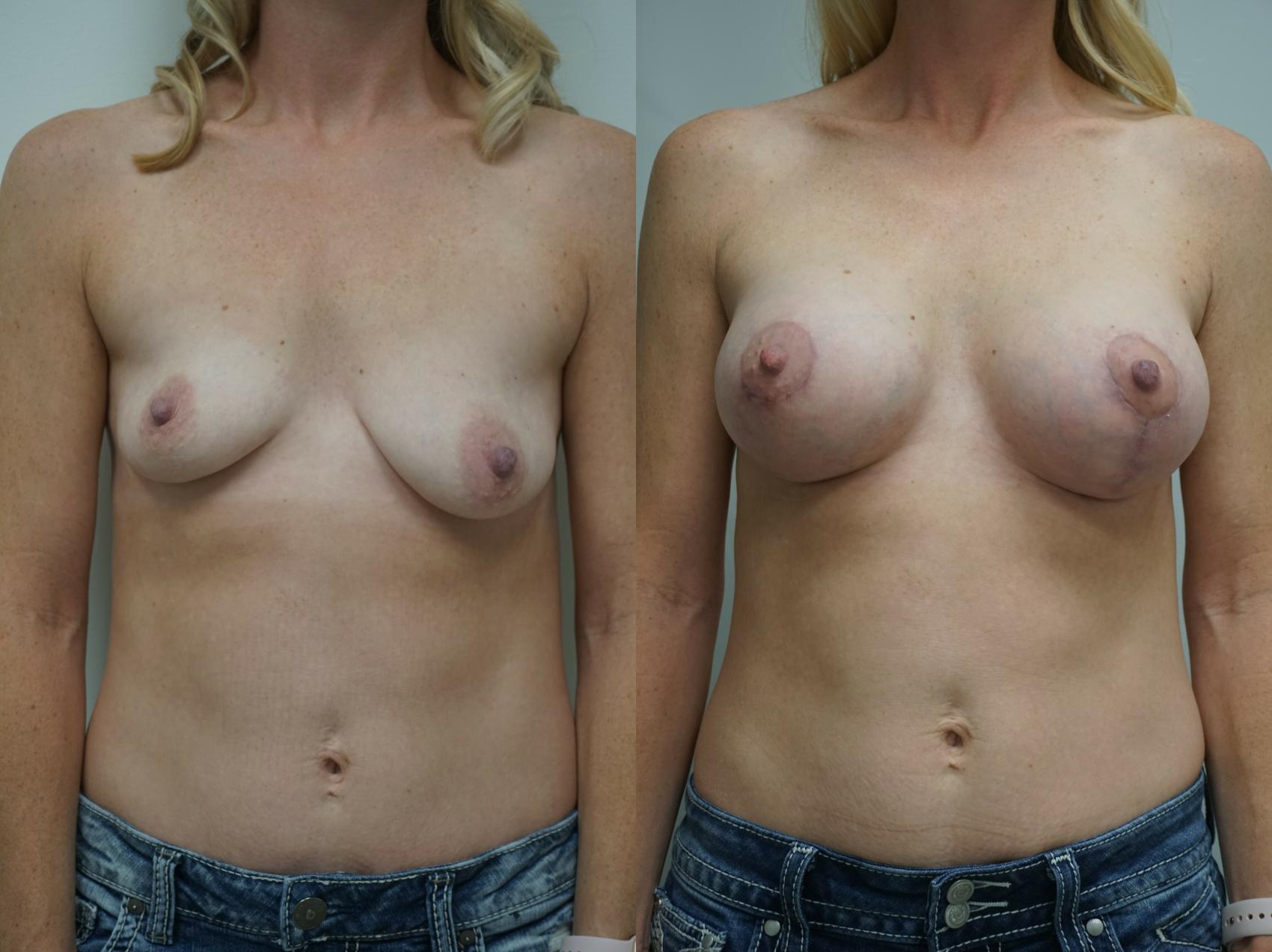 Before & After Breast Augmentation Case 218 View #1 View in Gilbert, AZ