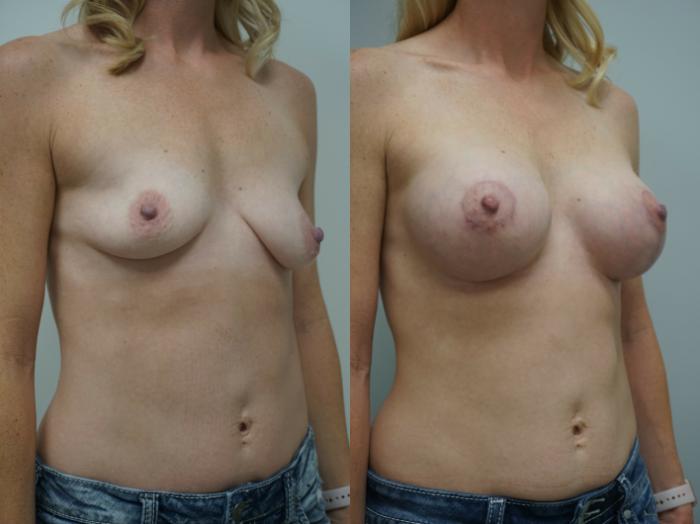 Before & After Breast Augmentation Case 218 View #2 View in Gilbert, AZ