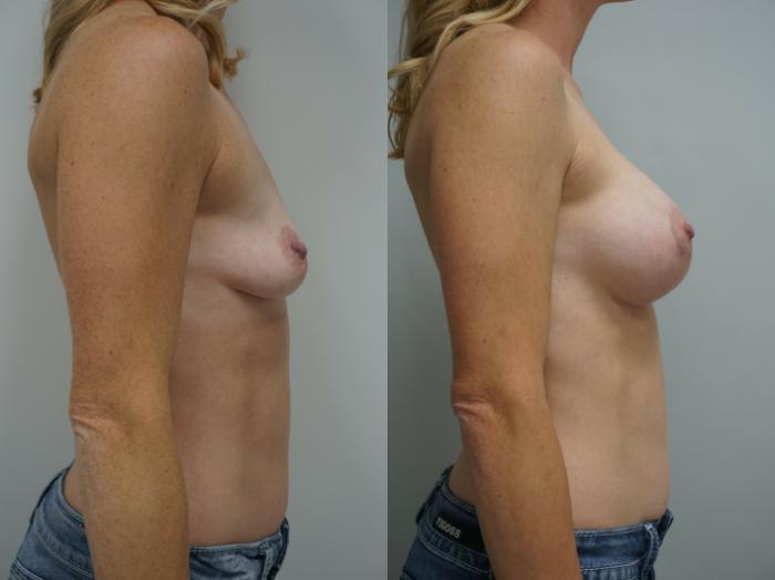 Before & After Breast Augmentation with Breast Lift  Case 218 View #3 View in Gilbert, AZ