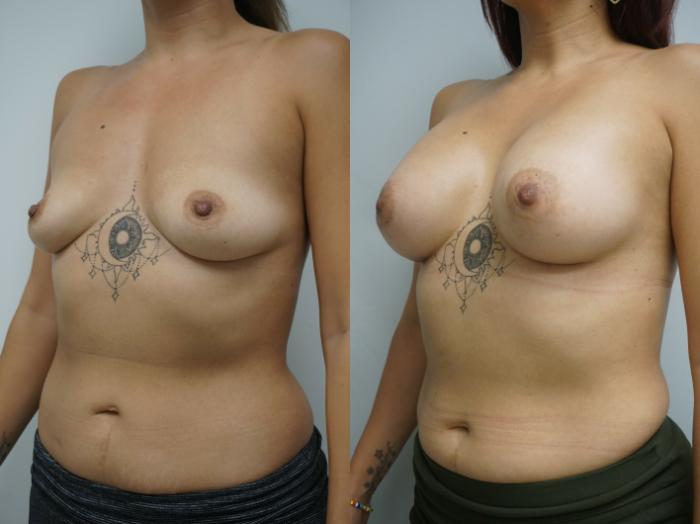 Before & After Breast Augmentation Case 219 View #1 View in Gilbert, AZ
