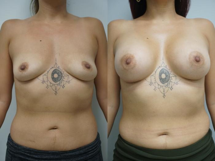 Before & After Breast Augmentation Case 219 View #2 View in Gilbert, AZ