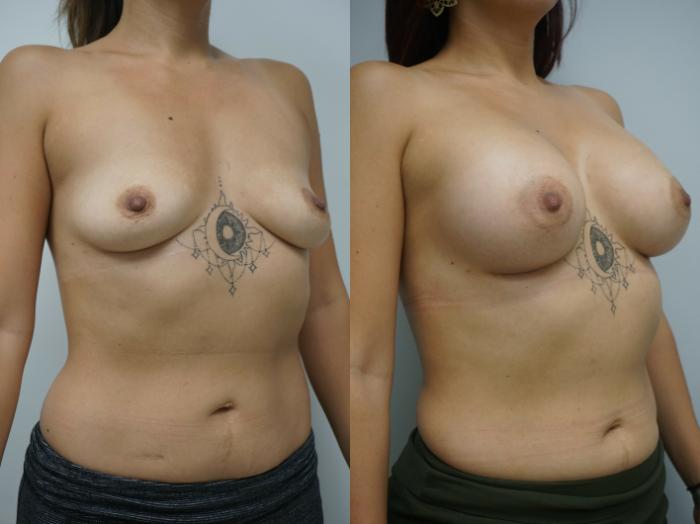 Before & After Breast Augmentation Case 219 View #3 View in Gilbert, AZ