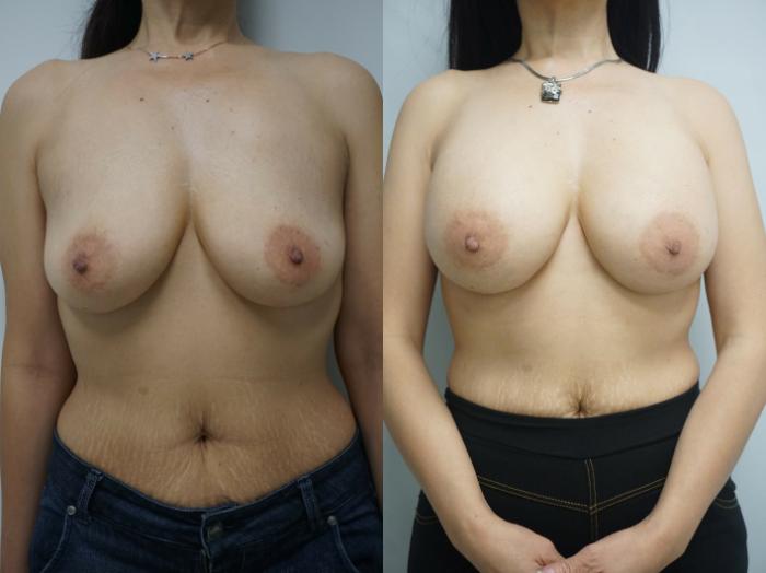 Before & After Breast Augmentation Case 221 View #1 View in Gilbert, AZ