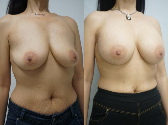 Before & After Breast Augmentation Case 221 View #2 View in Gilbert, AZ