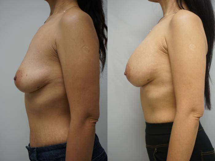 Before & After Breast Augmentation Case 221 View #3 View in Gilbert, AZ