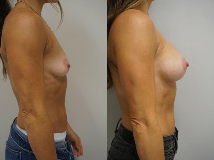 Before & After Breast Augmentation Case 225 View #1 View in Gilbert, AZ
