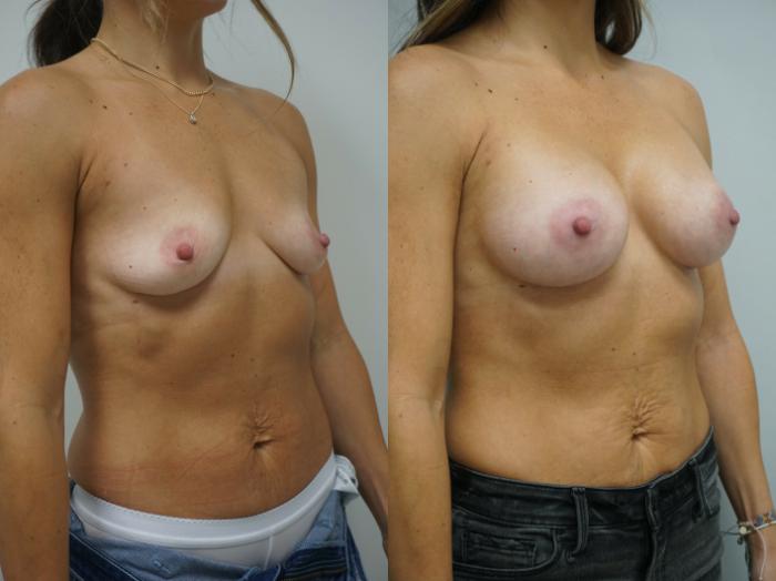 Before & After Breast Augmentation Case 225 View #2 View in Gilbert, AZ