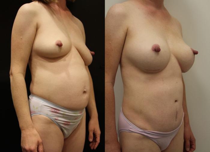 Before & After Breast Augmentation Case 23 View #1 View in Gilbert, AZ