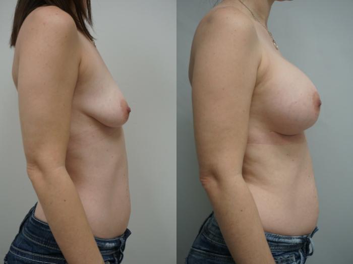 Before & After Breast Augmentation Case 230 View #2 View in Gilbert, AZ