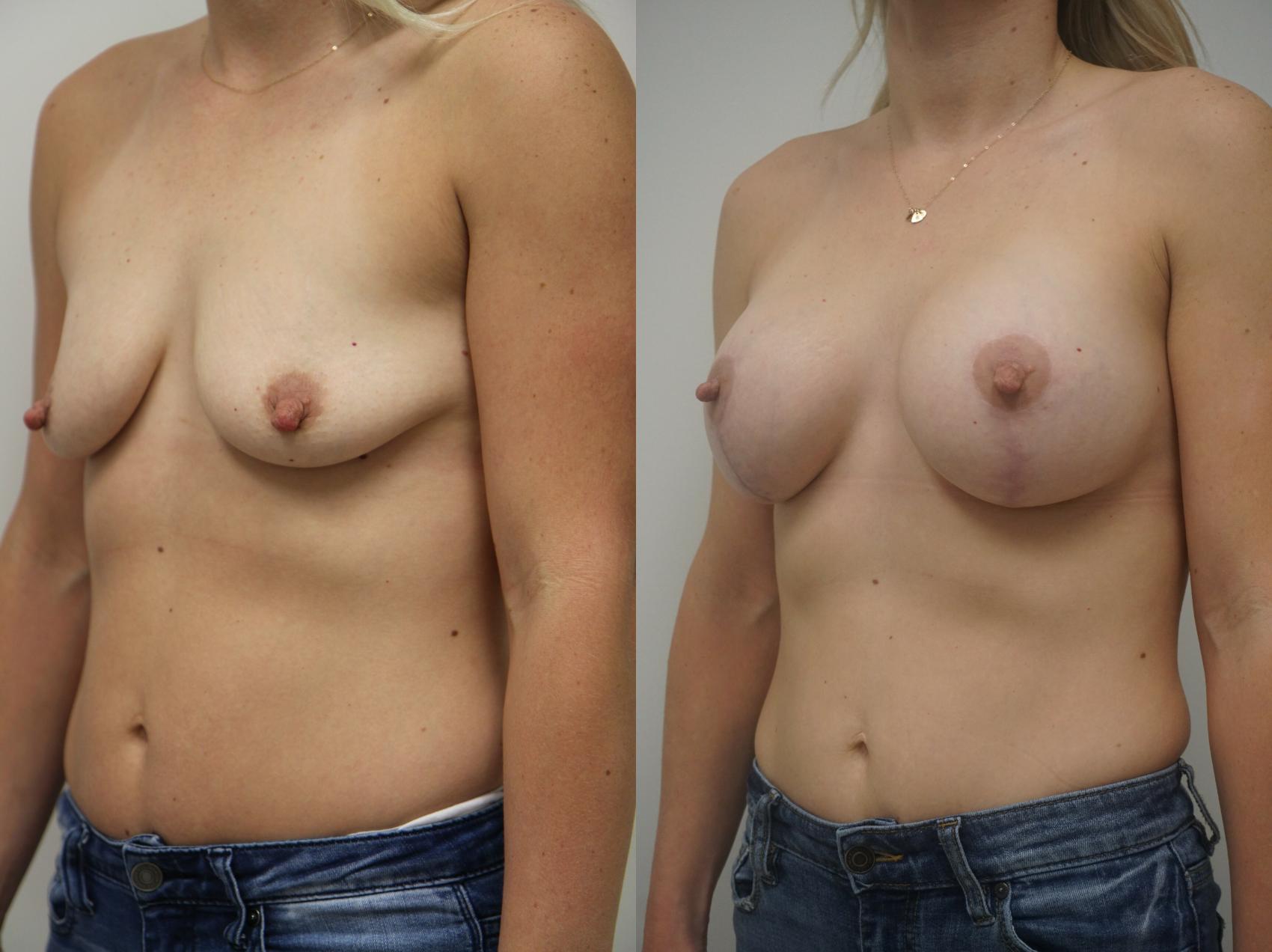 Before & After Breast Augmentation Case 232 View #1 View in Gilbert, AZ