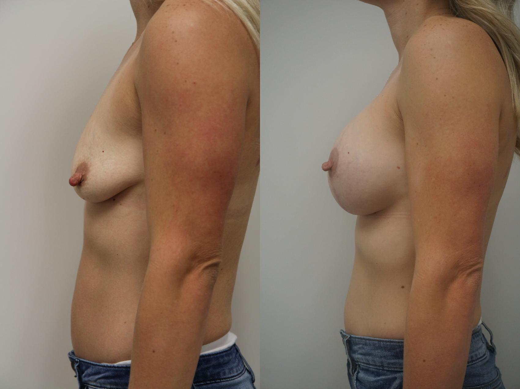 Before & After Breast Augmentation Case 232 View #3 View in Gilbert, AZ