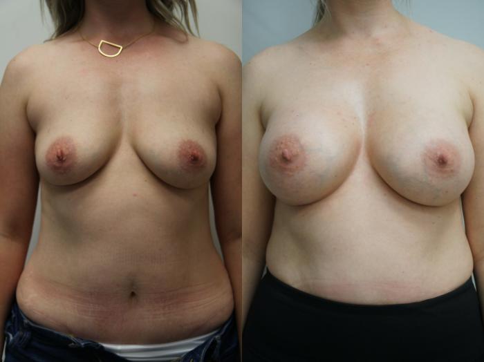 Before & After Breast Augmentation Case 234 View #1 View in Gilbert, AZ