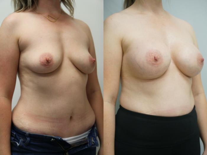 Before & After Breast Augmentation Case 234 View #2 View in Gilbert, AZ