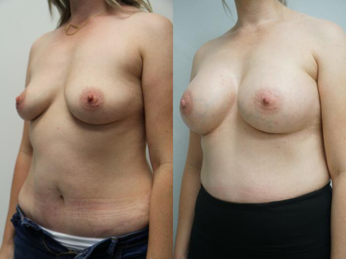 Before & After Breast Augmentation Case 234 View #3 View in Gilbert, AZ