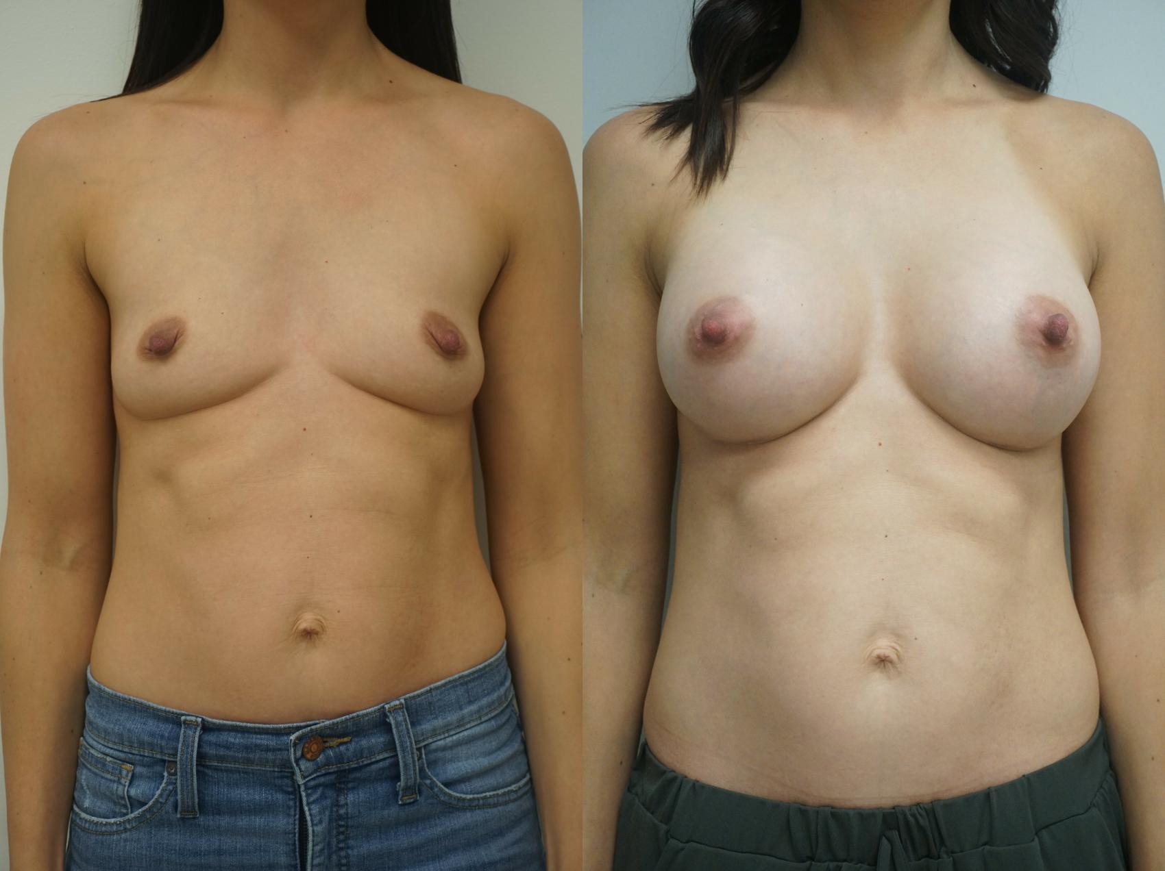 Before & After Breast Augmentation Case 238 View #1 View in Gilbert, AZ