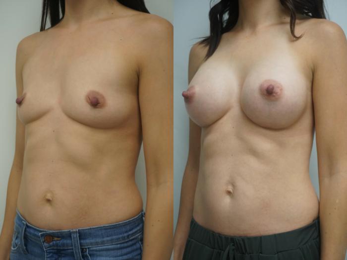 Before & After Breast Augmentation Case 238 View #2 View in Gilbert, AZ
