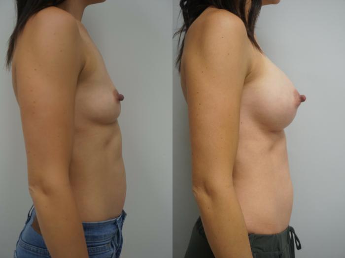 Before & After Breast Augmentation Case 238 View #3 View in Gilbert, AZ