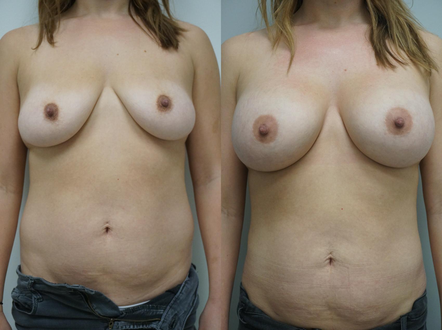 Before & After Breast Augmentation Case 240 View #1 View in Gilbert, AZ