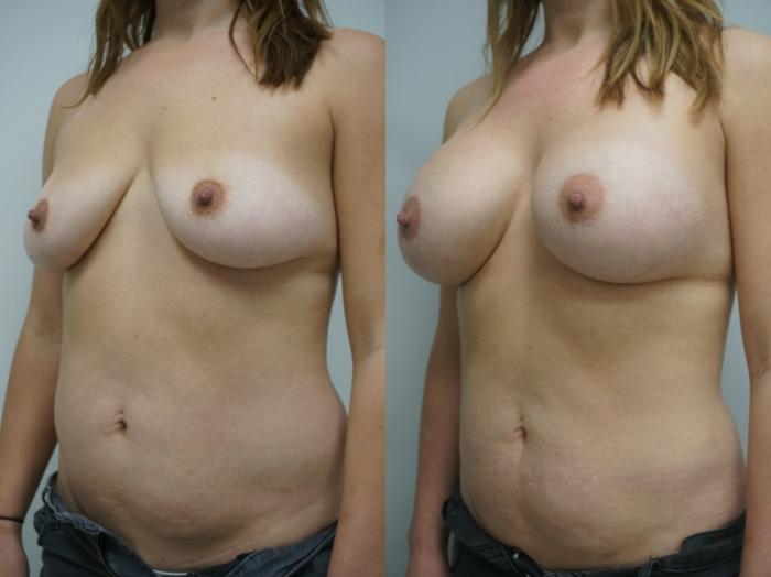 Before & After Breast Augmentation Case 240 View #2 View in Gilbert, AZ