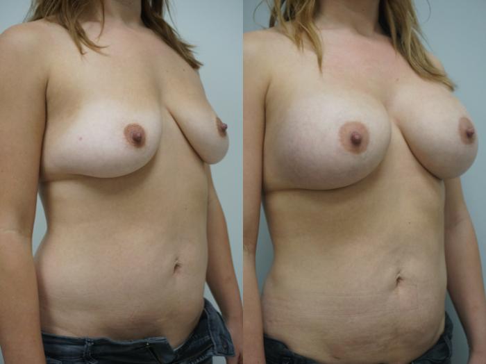 Before & After Breast Augmentation Case 240 View #3 View in Gilbert, AZ