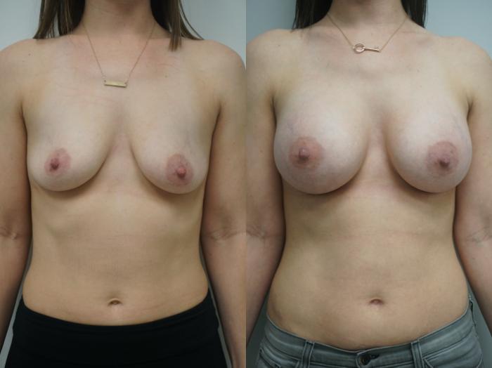 Before & After Breast Augmentation Case 243 View #1 View in Gilbert, AZ